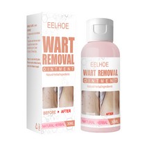 30ml 사마귀 치료 고약 사마귀 제거제 항균 연고 피부 라벨 제거제 약초 추출물 발 옥수수 고약 사마귀, 상품 상세페이지 참조