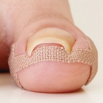 내성 발톱 방지 테이프 엄지 발톱 보호대