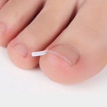 제이와이홀딩스 발톱파고들때 문제성 내향성 발톱 교정 팁 20P, 10P+10P