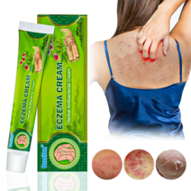 피부과 의사 추천 습진 피부 가려움 연고 피부가려움증 지루성피부염 치료 미국 FDA 인가 천연 허브 20g S-17