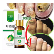 BT 발톱무좀 치료제 무좀약 무좀 케어제 발톱연화 무좀 관리, 1개, 30ml