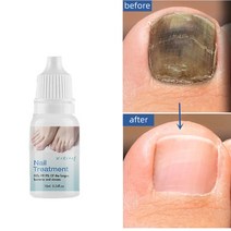 [당일배송] 1 1 발톱무좀치료 발톱 케어제 발톱연화 발톱 무좀 관리, 10ml × 4개, 1개, 1개