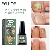 EELHOE 1+1 발톱무좀 발톱무좀치료 발톱 무좀약 진균 리페어 에센스, 15ml*2