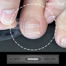[특허청 실용신안 의료기기] 퍼펙토 내성발톱 교정 자가치료 세트, 14mm 스트립 세트