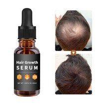 Hair Growth 원형탈모 탈모약 정수리 탈모 SERUM 30ML, 1병