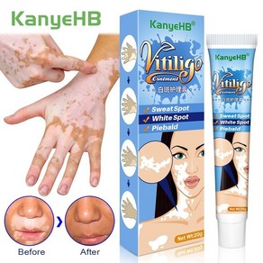 y존 겨드랑이 미백 착색크림 20g 초본 추출물 vitiligo 연고 백선 제거 화이트, 1개, 1개