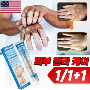 미국기술 1+1 백반증 치료 연고 손 목 얼굴 착색 피부치료 연고, 2개, 20g