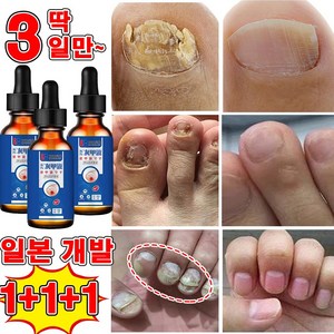 일본 개발 1/1+1 손톱 발톱 무좀 케어 앰플 발톱 영양제 발톱 관리 제거 문제성 발톱 100% 제거, 3개, 30ml