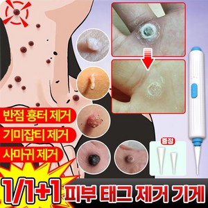 [당일출고] 피부 얼굴 태크 제거 기계 사마귀 기미잡티 셀프 제거 도구 페이스 뷰티 케어 반점 검버섯 빼는 기계, 1세트, 블루