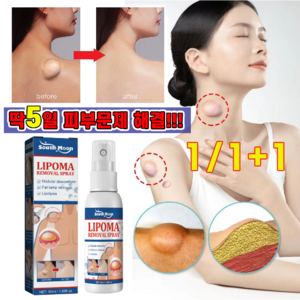 1/1+1 피지낭종 제거 스프레이 지방종 완화 표피낭종 제거 연고 바디케어 크림, 50ml, 1개