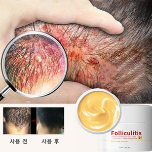 두피 가려움증 두피염 여드름 모낭염 건선 치료 두드러기 허브 연고, 30ml, 1개